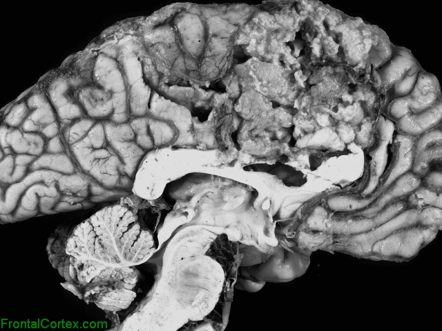 Anterior cerebral artery infarct, sagittal section through brain and brainstem.